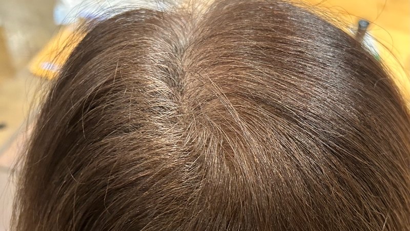 【白髪・薄毛は治る？】頭皮マッサージで改善する可能性のある例